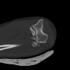 SPORK, NICO - 22.03.1976 - 02.08.2022 - CT obere Extremität - 18:02:23